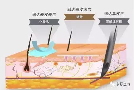微针手术护理全过程,微针治疗操作规范
