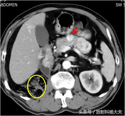 肾癌脑转移还会扩散其它部位吗,肾癌手术后10年转移了还有办法吗