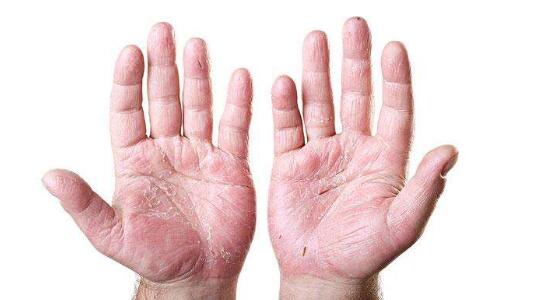 十岁小孩手脚脱皮是什么原因,手脚遇水脱皮是什么原因