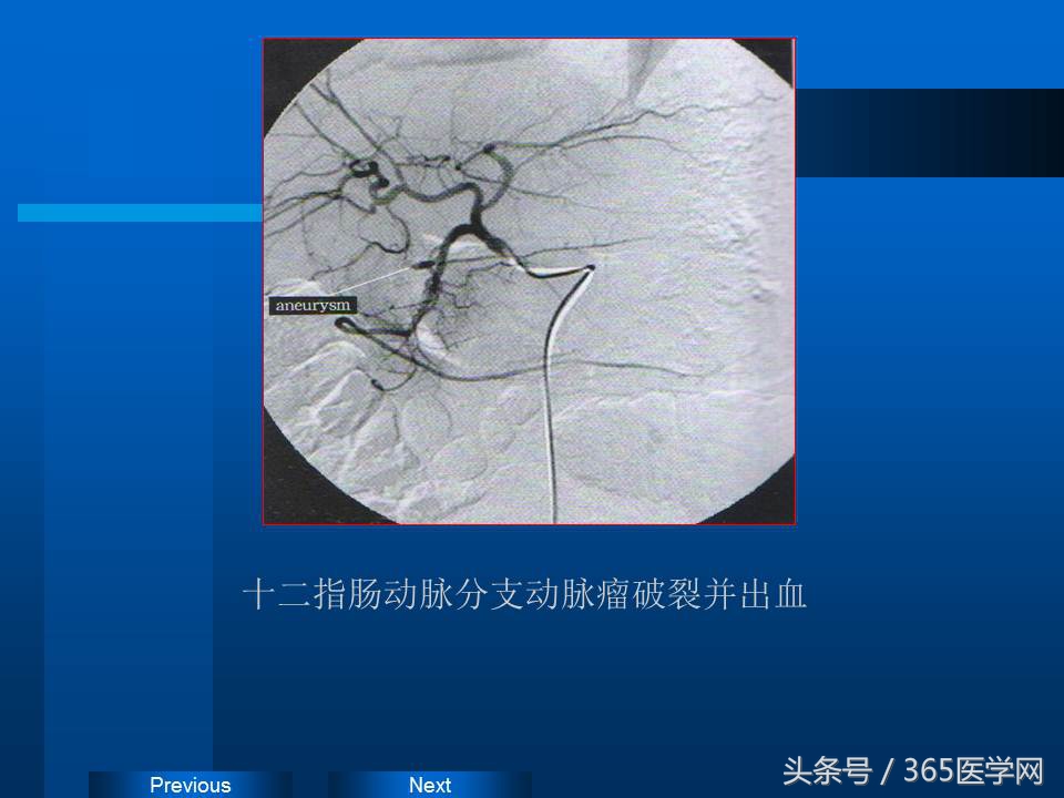 崔进国：消化道出血的介入治疗