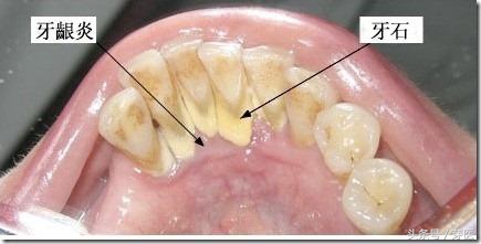 洗牙如何避免牙缝变大,闽侯南屿洗牙后牙缝变大
