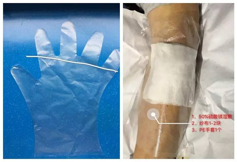 造影剂外渗用什么敷料,造影剂外渗后怎么处理