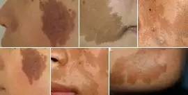 宝宝咖啡斑长在眼皮上,宝宝咖啡斑自己消失了