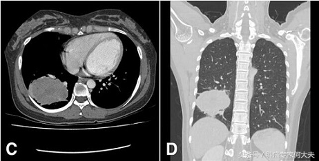 不幸得癌症怎么办,不幸确诊了肺癌要积极治疗