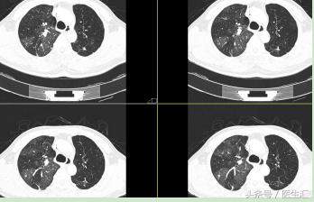 两年了老是咳嗽怎么回事,老人稍微活动气急气喘怎么办