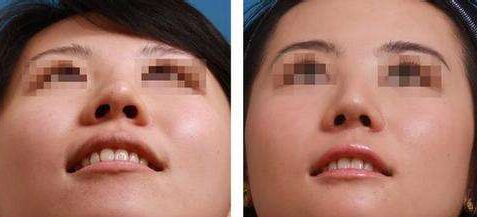 做了隆鼻手术怎么都不消肿,做隆鼻手术失败有哪些症状