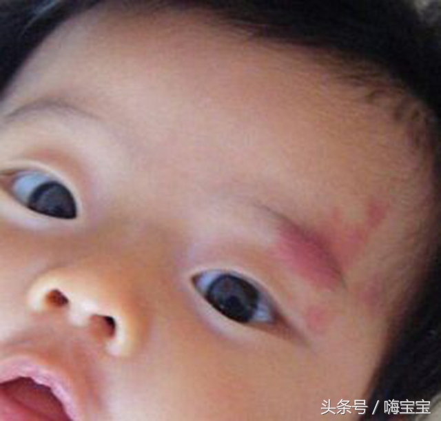 青色胎记会影响健康吗,小孩的胎记会影响身体吗