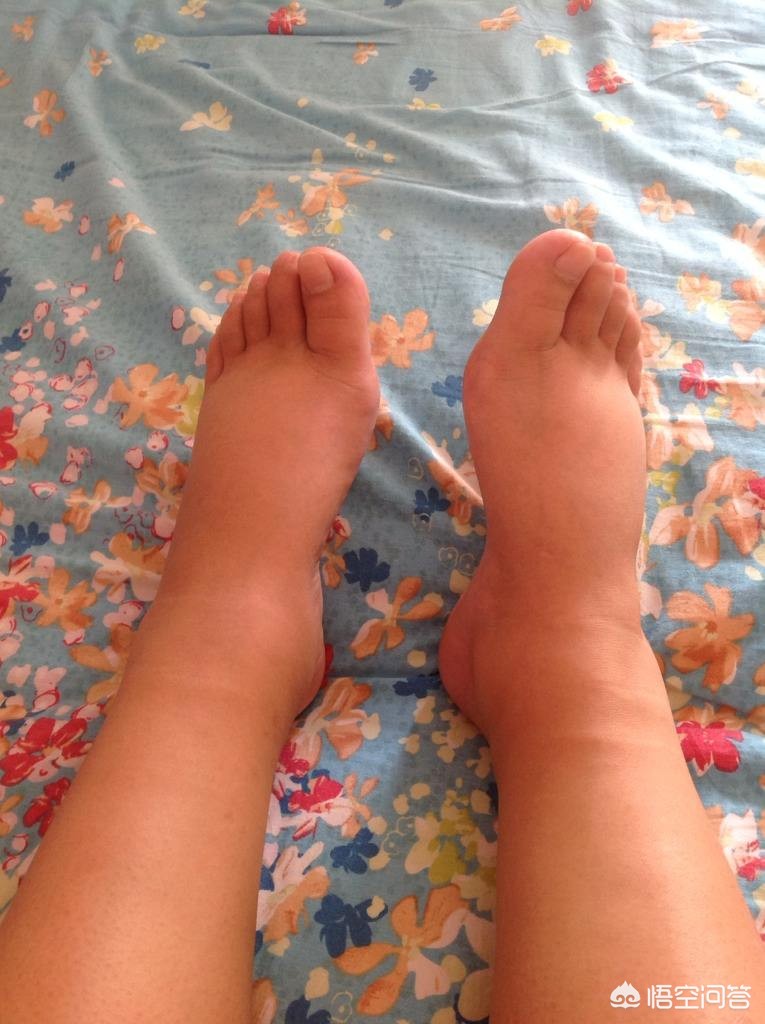 骨折手术后是麻木好还是疼好,骨折术后静脉血栓症状表现