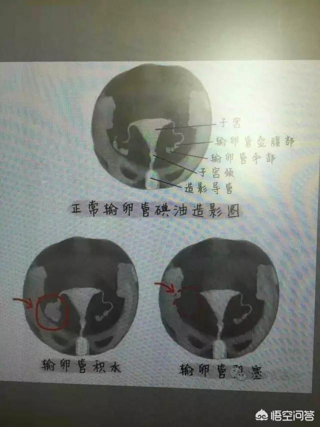 怎样证明输卵管是通的,怎么证明输卵管是通的自测