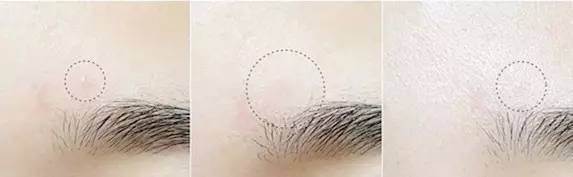 祛痘神器痘痘的克星,和痘痘疯狂抗争的经历