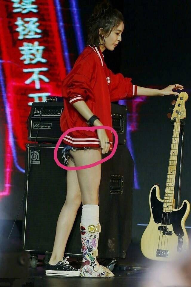 白百何与古力娜扎,娜扎打石膏