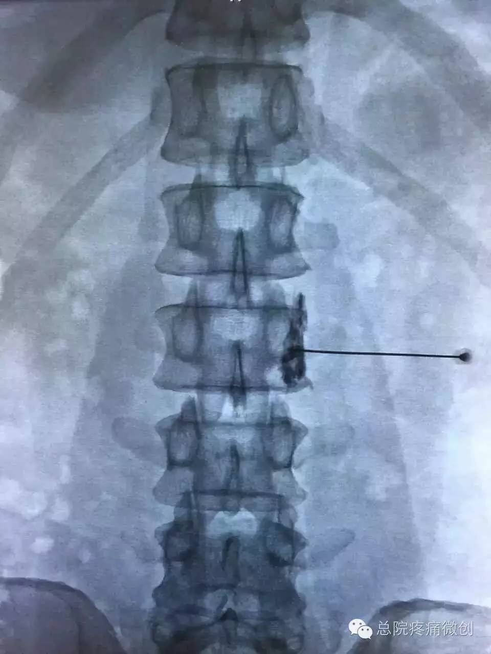 疼痛科治疗脚板痛的视频,疼痛科有哪些技术