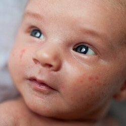 宝宝小红疙瘩怎么回事,宝宝小疙瘩