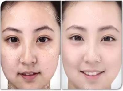 激光治疗祛雀斑,激光祛雀斑的最佳方法