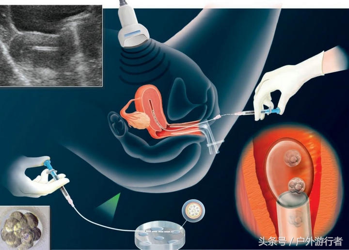 试管宝妈成功案例讲解,试管婴儿宝妈的经历