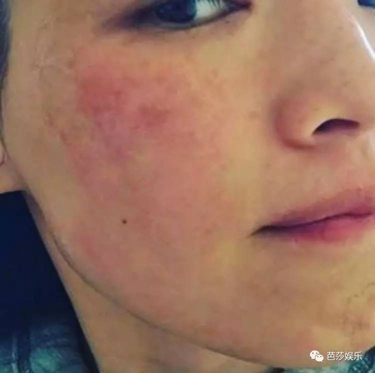 舒淇过敏发作视频,舒淇过敏