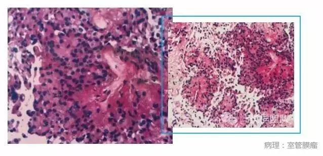 闫长祥脑膜瘤,闫长祥能治愈弥漫中线胶质瘤吗
