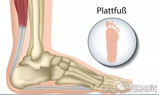 扁平足的矫正方法,2岁扁平足需要矫正么