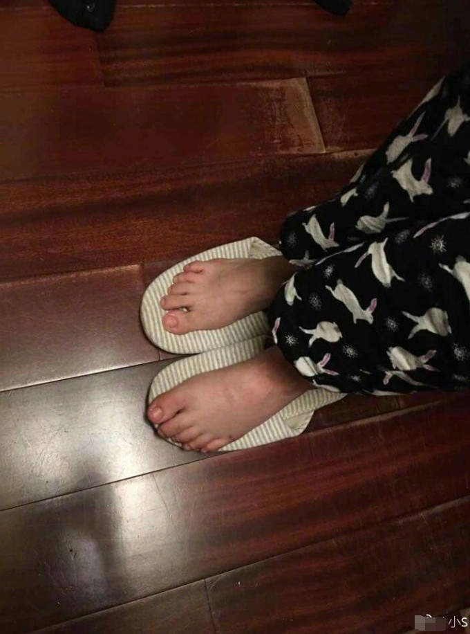 小S经过针灸2次已可慢步走路大赞中医博大精深