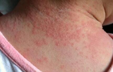 小孩热疹湿疹怎么区别,小孩热疹和湿疹的区别