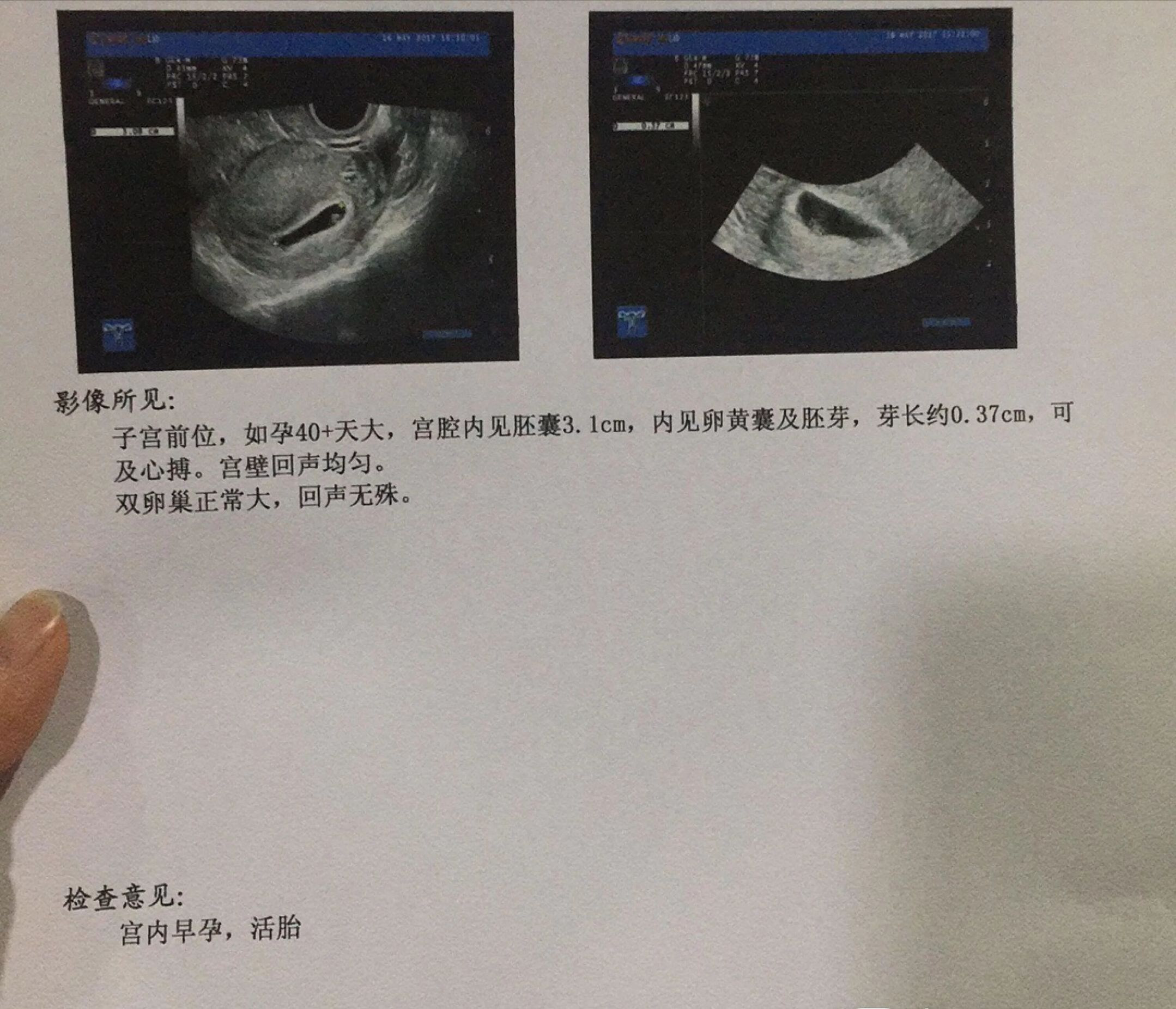 幸运降临，提心吊胆妈妈怀孕历程