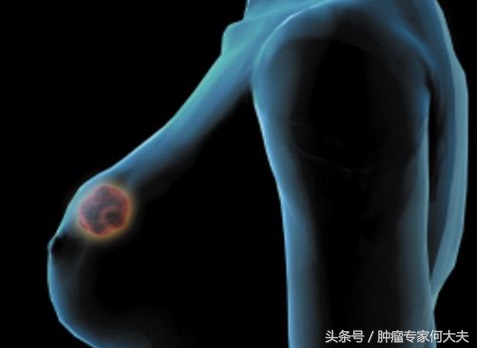 乳腺增生如何才能发展为乳腺癌,中医中药能治乳腺浸润性乳腺癌吗