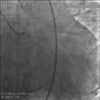 急性心肌梗死心源性休克时的处理,急性心肌梗死心源性休克最常见