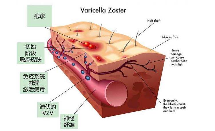 水痘高发季这波操作助你轻松战痘,水痘高发期战痘功略