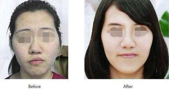 浙江有兔唇修复吗,成年人兔唇疤痕修复