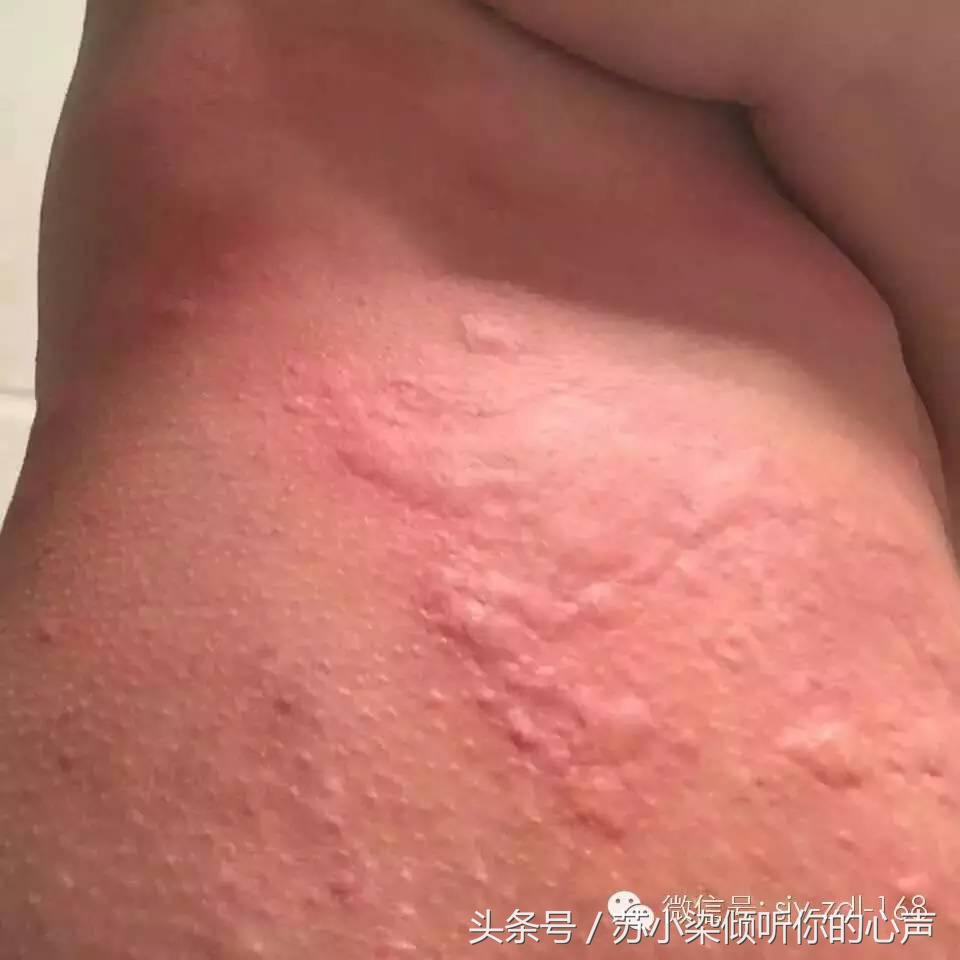 沙棘油，对皮肤还有如此神奇的效果