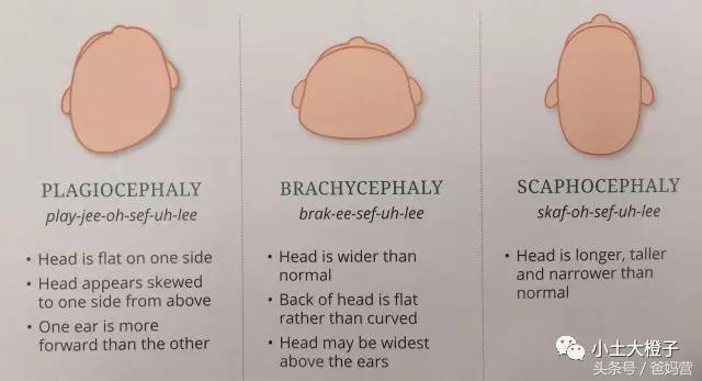 美国的宝宝扁头为什么要矫正,扁头在国外要做矫正吗