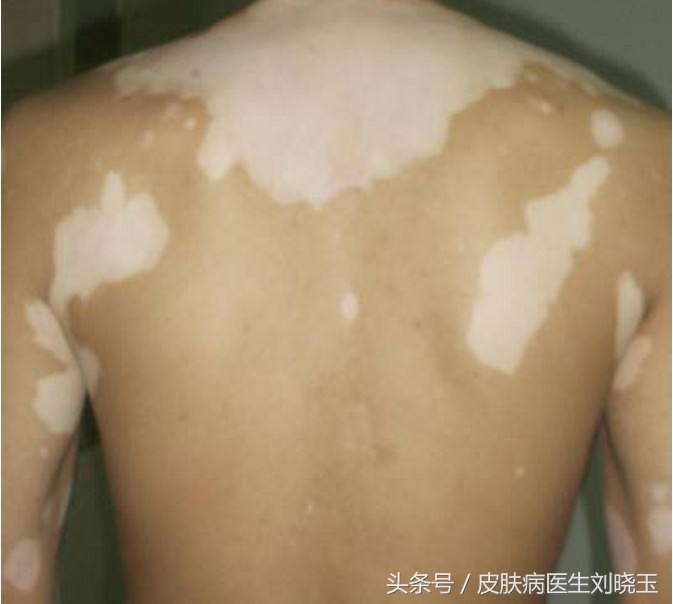 白癜风名医药方,治疗白癜风著名专家护理措施