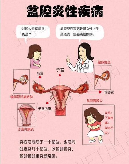 盆腔炎性疾病要怎样治疗,盆腔炎性疾病的正确治疗方法