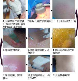 全国治疗白癜风自愈的最佳方法,白癜风的综合疗法效果怎么样