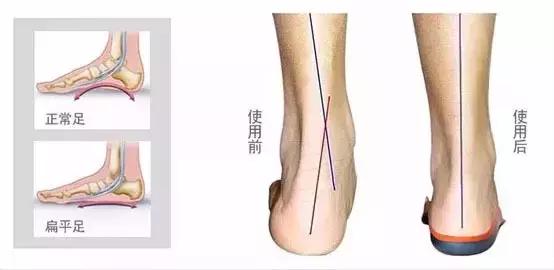 长时间走路脚跟痛怎么解决,足弓和脚后跟痛怎么回事