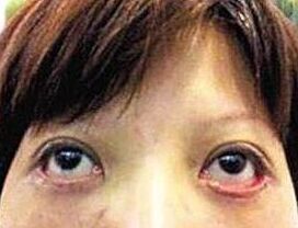 上眼睑轻微外翻有办法治疗吗,眼睑外翻治疗方案
