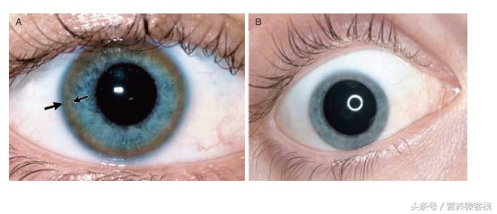 肝豆状核变性有什么症状,肝豆状核变性能吃山药吗