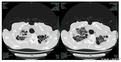 晨起胸闷气短心跳加速,晨起胸闷气短呼吸困难是怎么了