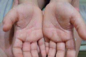 皮肤瘙痒脱皮是什么原因,双手瘙痒是什么原因引起的