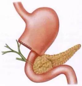 胃镜预处理流程,胃镜内镜手术全流程