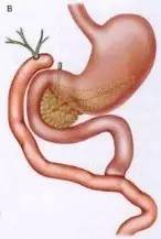 胃镜预处理流程,胃镜内镜手术全流程