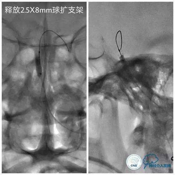天坛周记,天坛医院脑动脉狭窄
