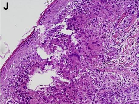 腹泻的不同类型及病例,腹泻的不同原因及现象