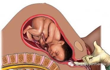 妊娠36周宝宝,胎儿命悬一线医生托举24分钟救命