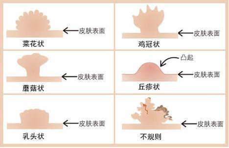 肛门长了一片肉疙瘩,她跟医生这么说