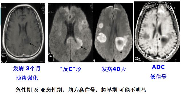 医学干货：瘤样炎性脱髓鞘病与胶质瘤、PCNSL临床、影像鉴别