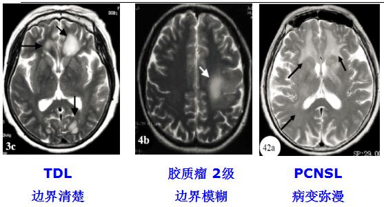 医学干货：瘤样炎性脱髓鞘病与胶质瘤、PCNSL临床、影像鉴别