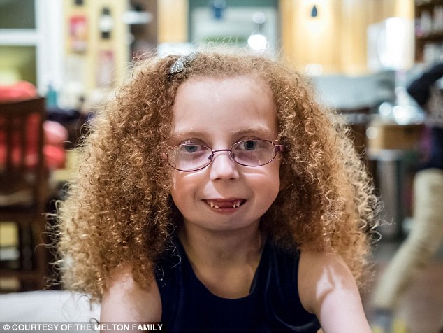 没有下巴的女孩长什么样子,一出生就没有胳膊的女孩