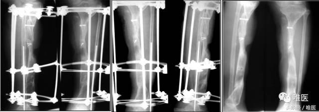 胫骨骨折骨缺损多大可以自愈,胫骨骨折有小块骨缺损影响吗