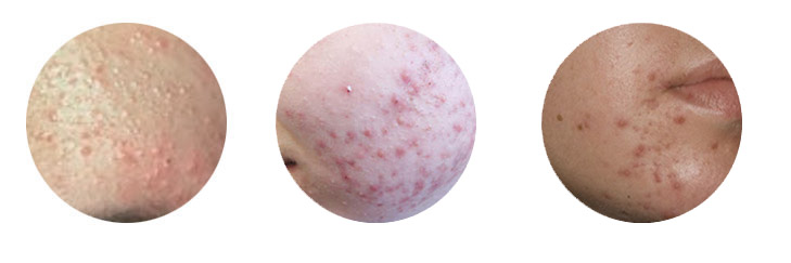 一篇没有噱头不抓眼球但缺切实有用的抗痘护理文章，给有需要的你